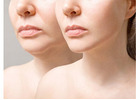 What are the Different Procedures for Facial Plastic Surgery?